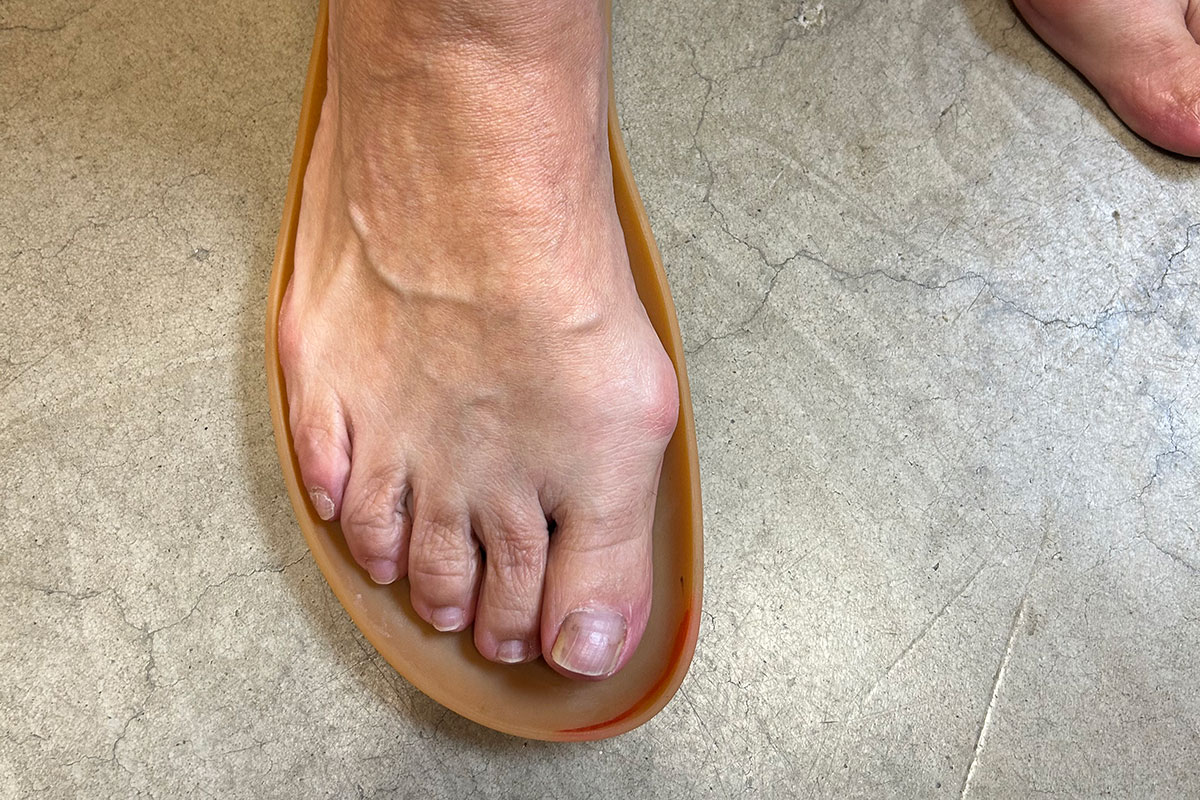 Fuß mit Hallux Valgus in einer Barfußschuh Sohle