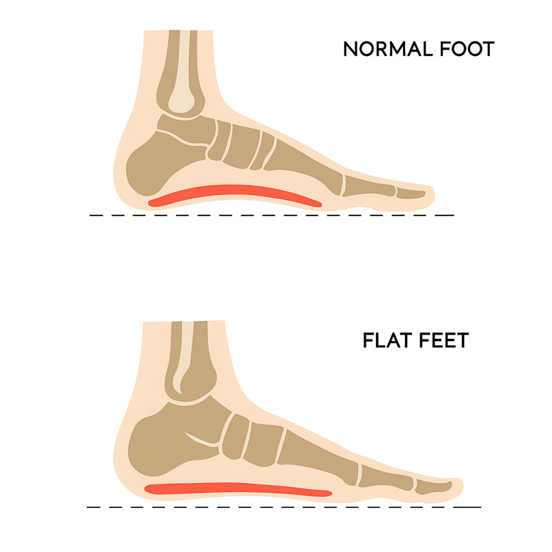 plattfuss-800-800 grafik plattfuß im vergleich zum normalen fuß