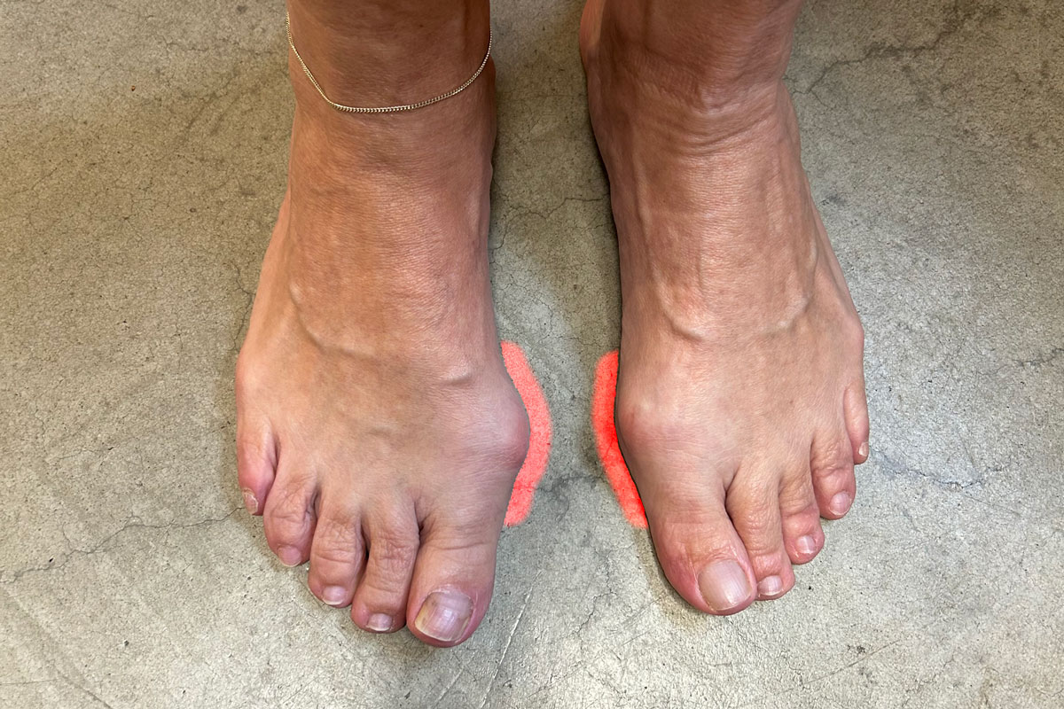 füße mit hallux valgus problem