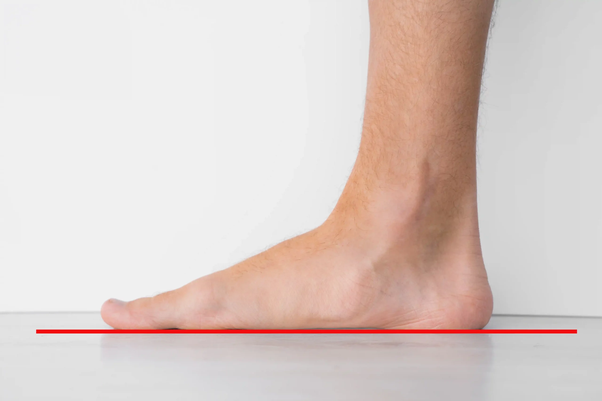 Plattfuss und Senkfuss