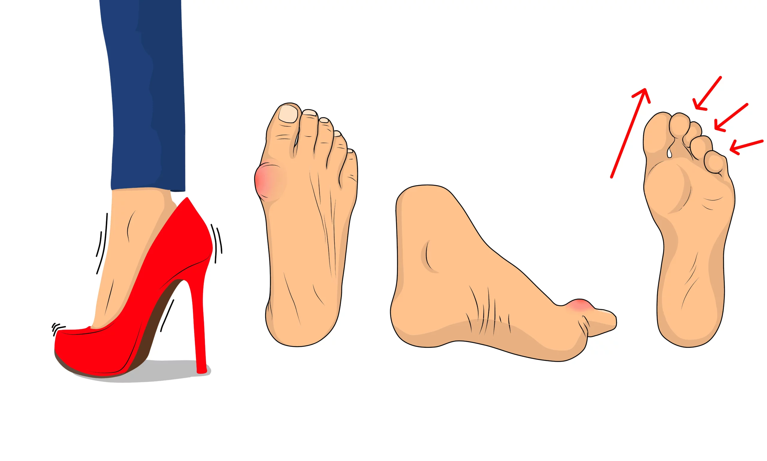 verschiedene Abbildungen von Fußdeformitäten