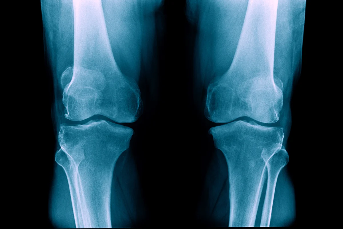 röntgenaufnahme der knie bei knieschmerzen