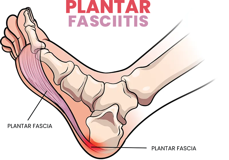 grafik zur plantarfaszie