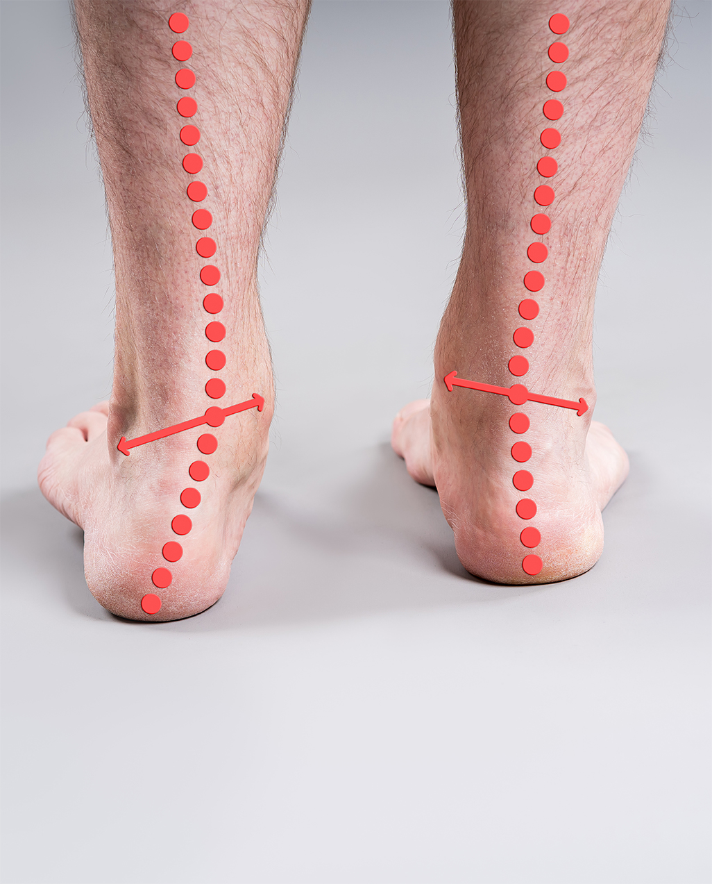 Überpronation Fuß knickt zu stark nach innen ein